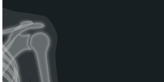 Peties sąnario artrozė