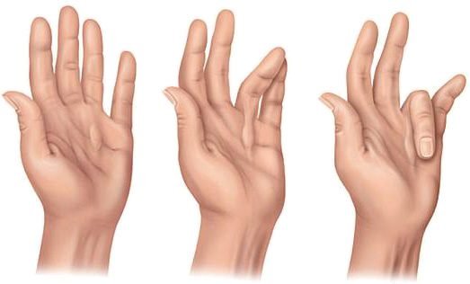 Dupuytreno kontraktūros